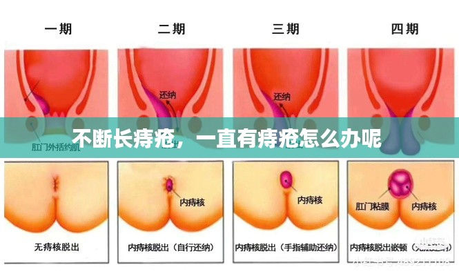 不断长痔疮，一直有痔疮怎么办呢 