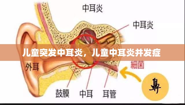 儿童突发中耳炎，儿童中耳炎并发症 